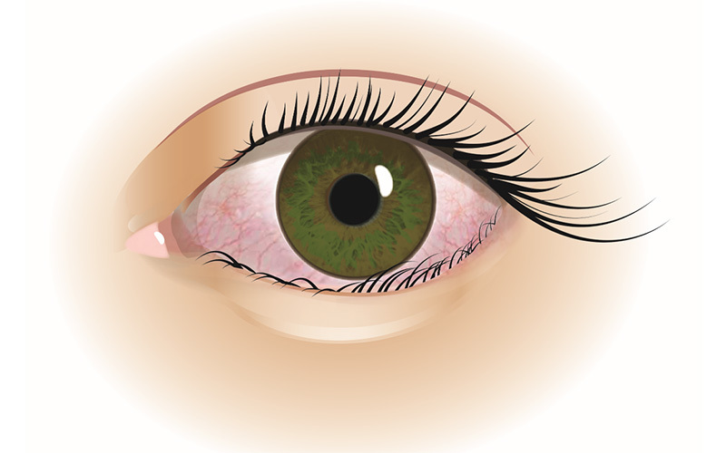 Nærbillede af indadvendte øjenlåg med entropion