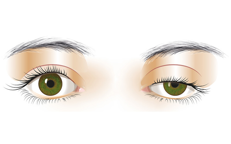 Tunge øjenlåg (Ptosis)