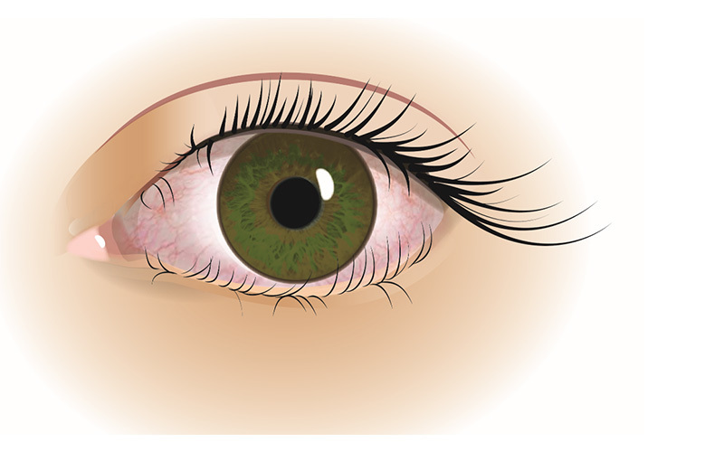 Øjenvipper, der vender indad (trichiasis)