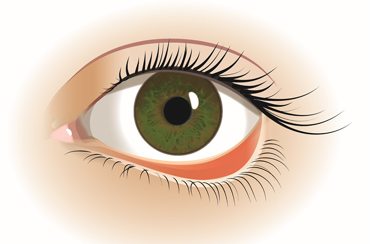 Udadvendt øjenlåg (ektropion)
