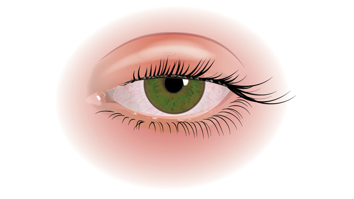 Blefarit gør øjenlågskanterne røde, irriterede og hævede.