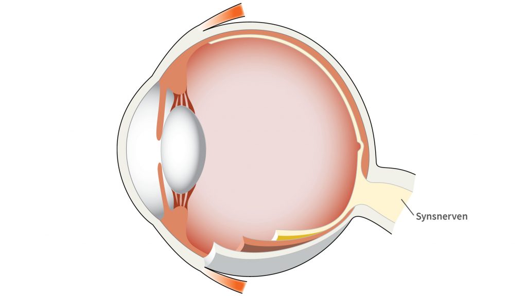 Illustration af øjets anatomi, der viser synsnerven (optikusnerven) og betændelse i nerven ved synsnervebetændelse (optikusneurit).