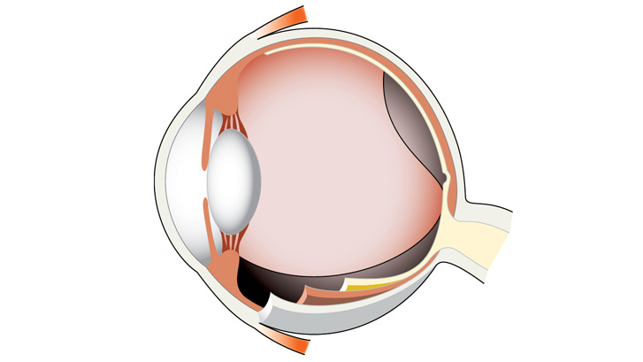 Glaslegemeløsning indebærer at glaslegemet løsner sig fra sin faste placering mod nethinden.