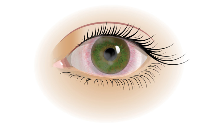 Keratit er en betændelse i øjets hornhinde, som ofte kan forårsage røde øjne og være meget smertefuldt.