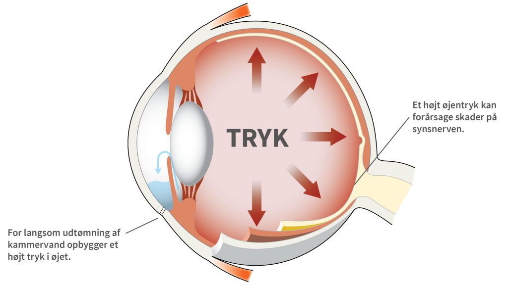Glaukom opstår ofte pga. at et højt øjentryk har forårsaget skader på synsnerven.